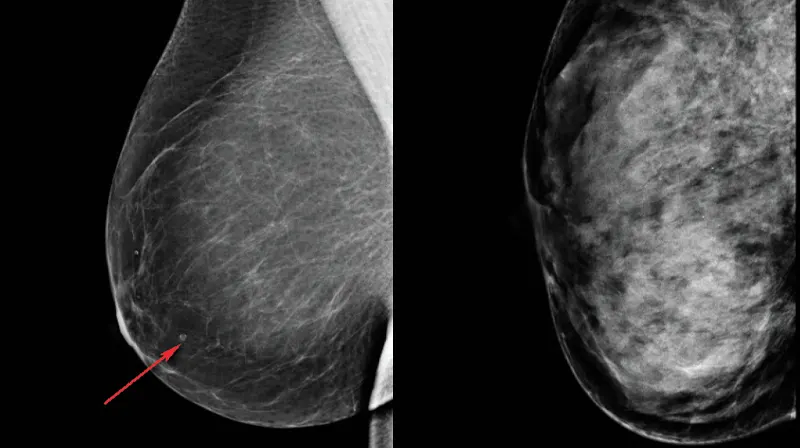 Dense Breasts Mammography