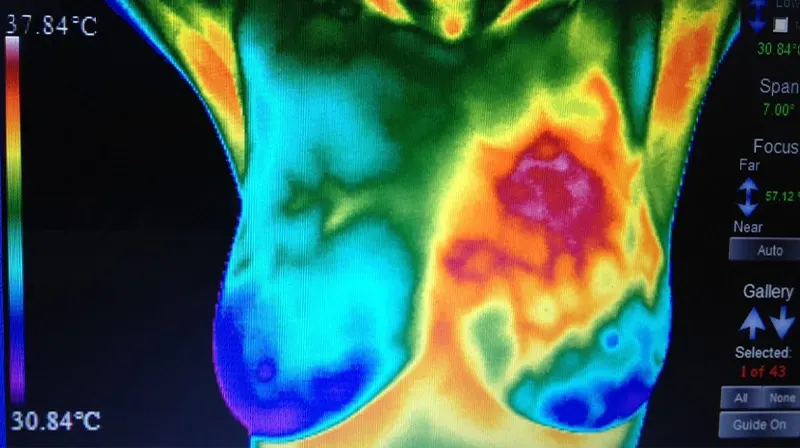 Thermogram Breasts