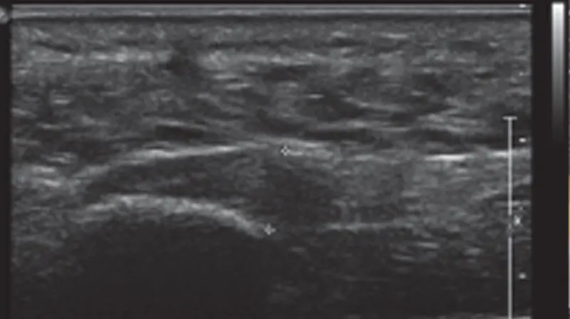 Ultrasound of the Feet